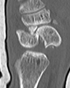 scaphoid
