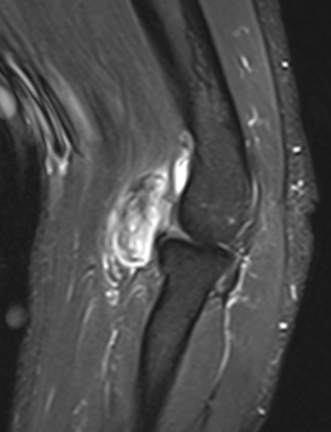 Synovial sarcoma elbow 2