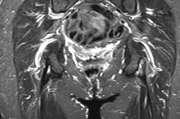 Tendinopathy