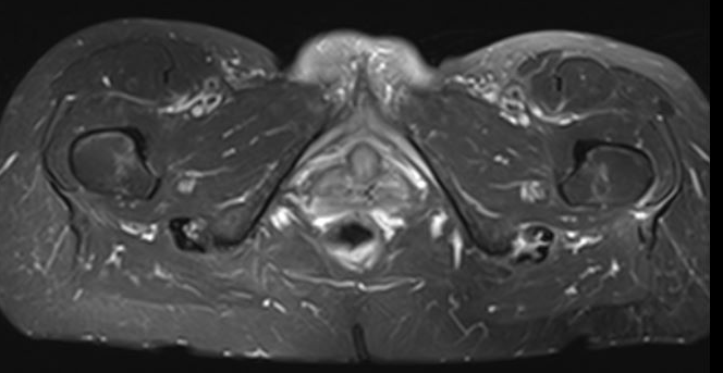 Tendinopathy