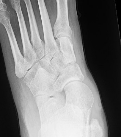 AP foot
