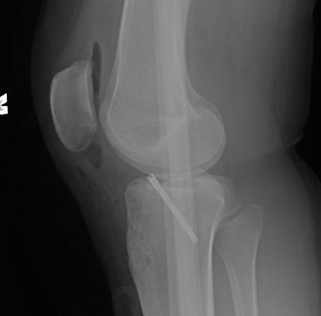acl avulsion