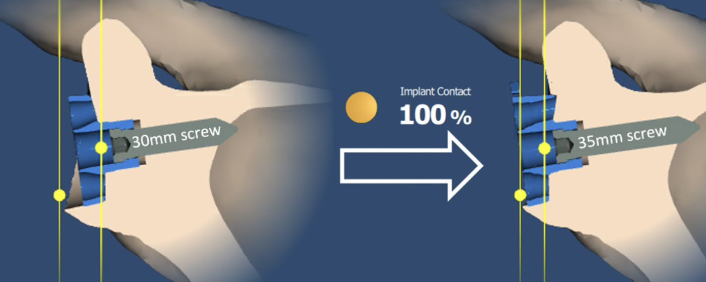 Glenoid augments