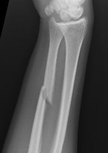 ulna