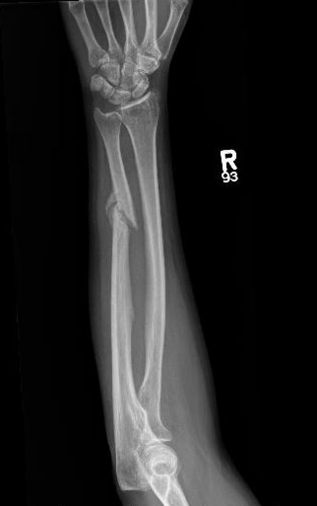 ulna