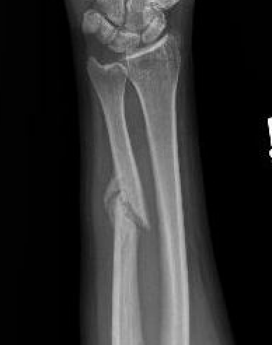 ulna