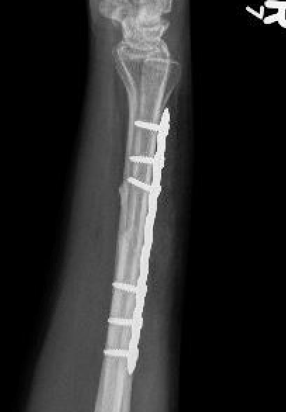 ulna