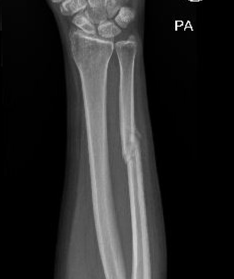 ulna nonunion