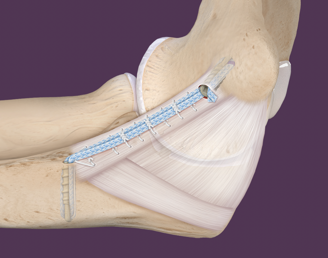 Arthrex internal brace