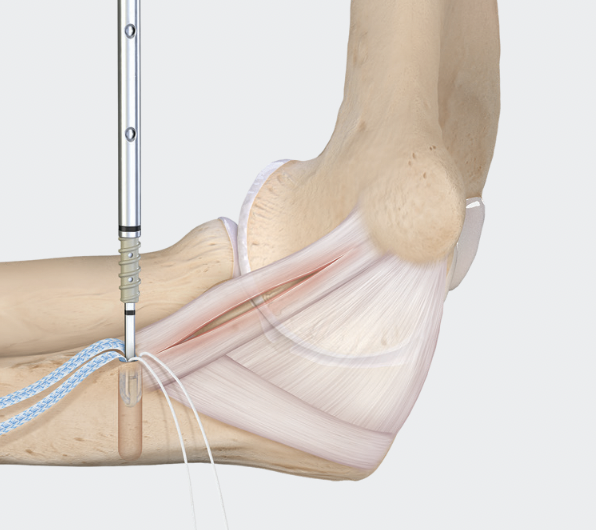 Arthrex internal brace