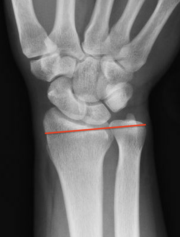 ulna