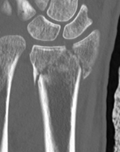 distal radius