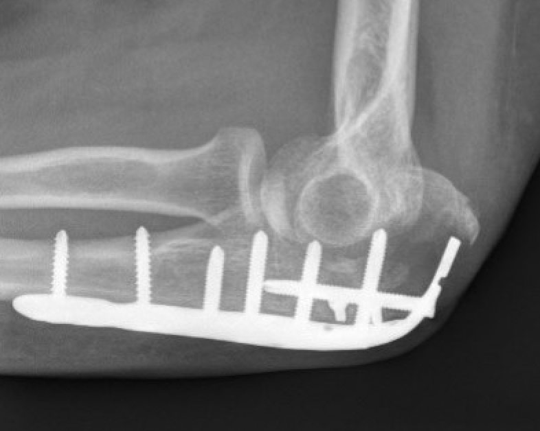 olecranon fracture