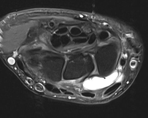 ganglion mri