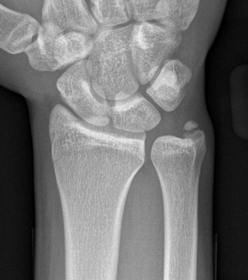 ulna styloid