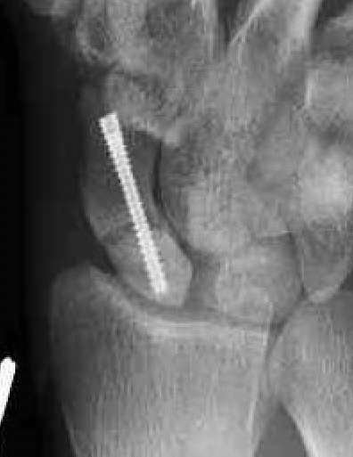 AVN screw