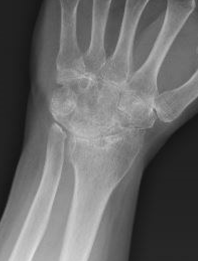 arthro
