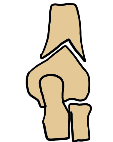 osteotomy