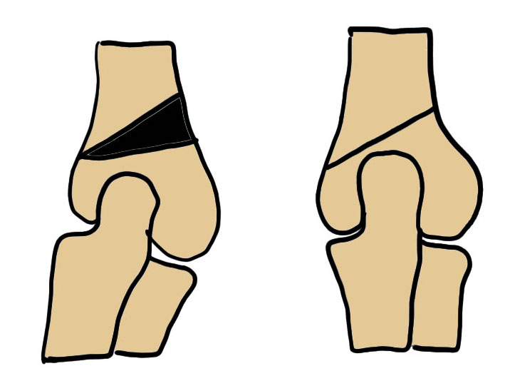 osteotomy