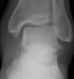 Lateral process fracture