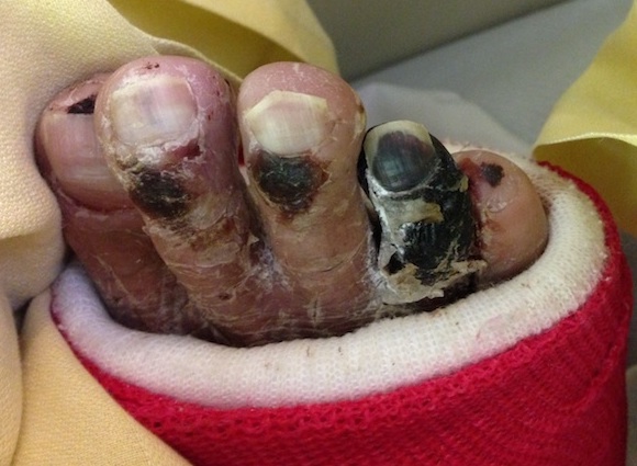 Gangrene