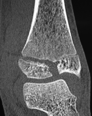 triplanar
