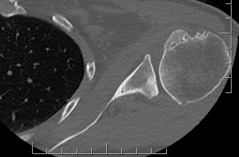 Type B2 glenoid