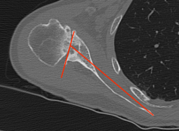 Friedman method glenoid version