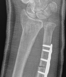 ulna shortening