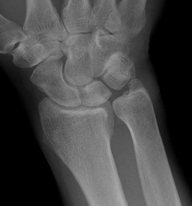 ulnocarpal