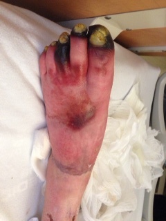 Gangrene