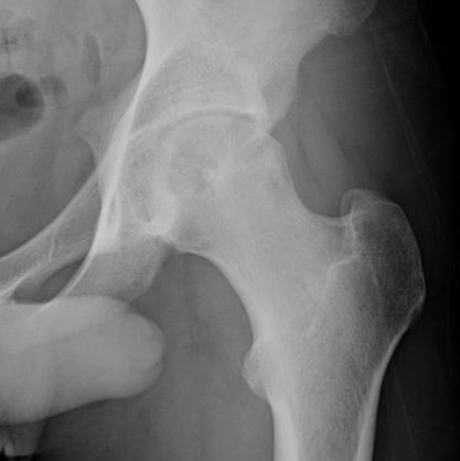 Femoral head chondroblastoma