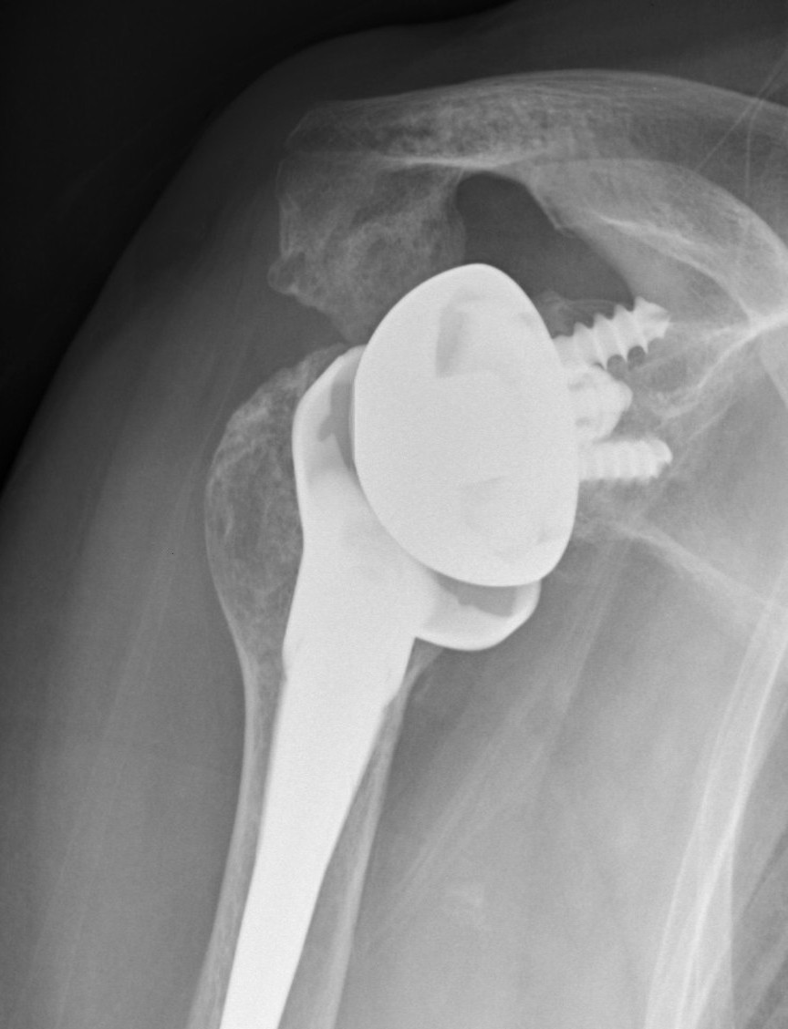Acromial stress fracture
