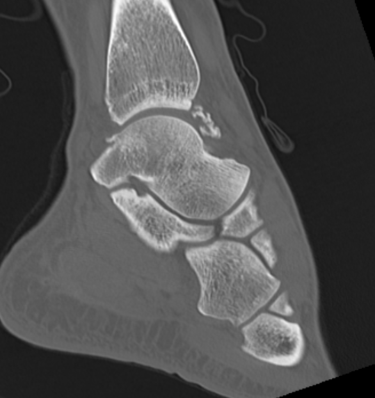 Ankle synovial osteochon