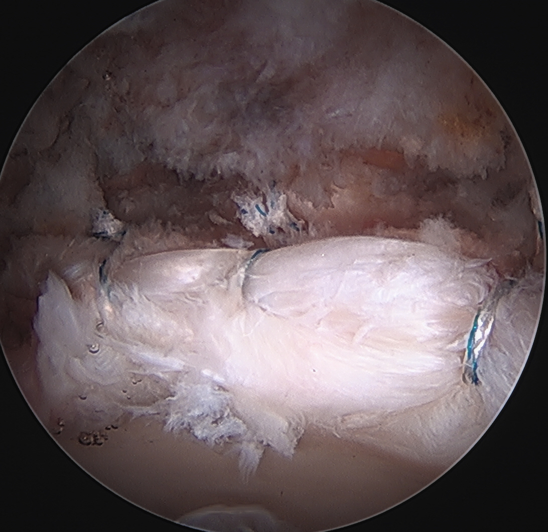 Labral repair 2