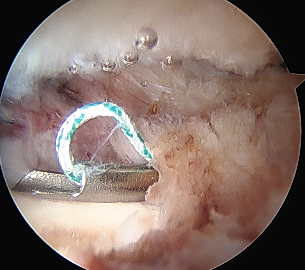 Distal capsule suspension