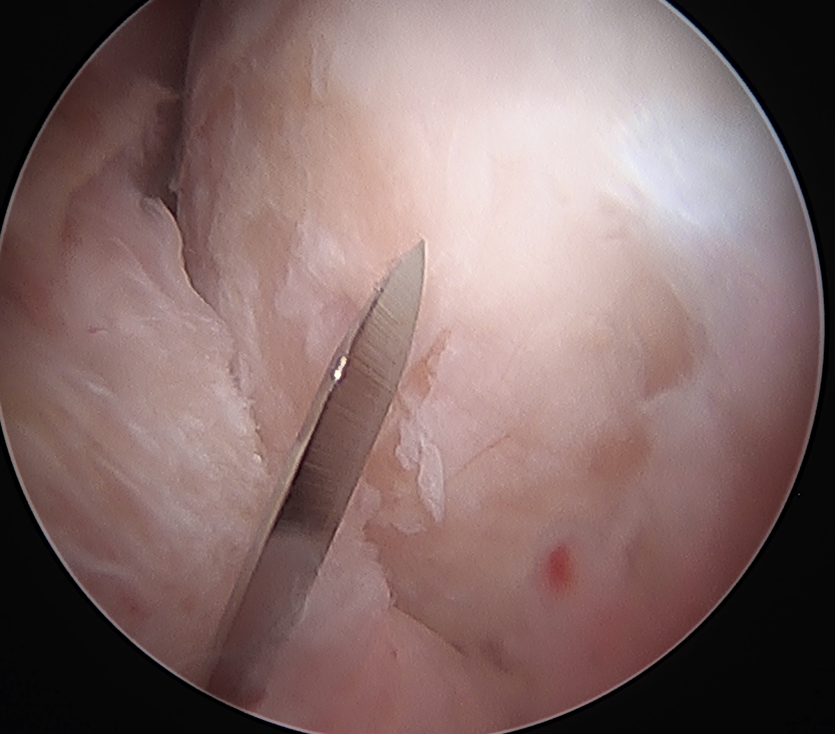 T Capsulotomy 2