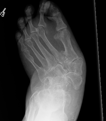 Charcot