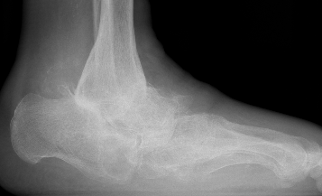 Charcot
