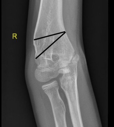 Corrective osteotomy