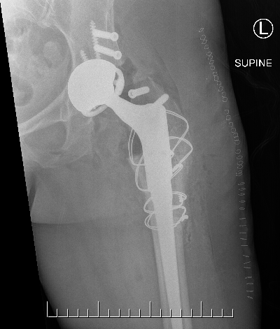 Hip fusion conversion 1