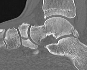 navicular CT