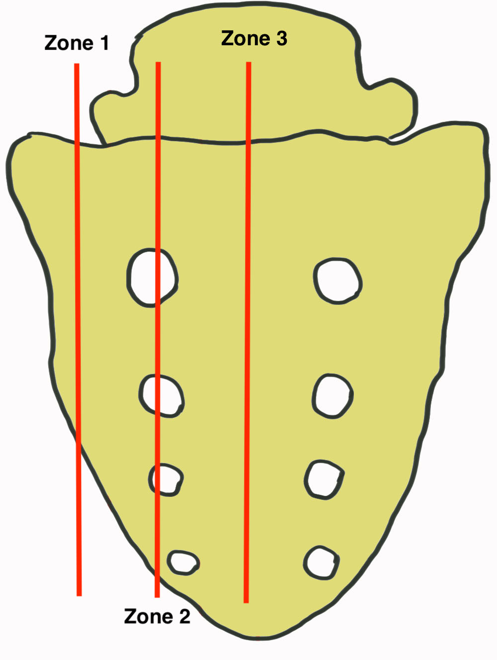 Sacral fractures